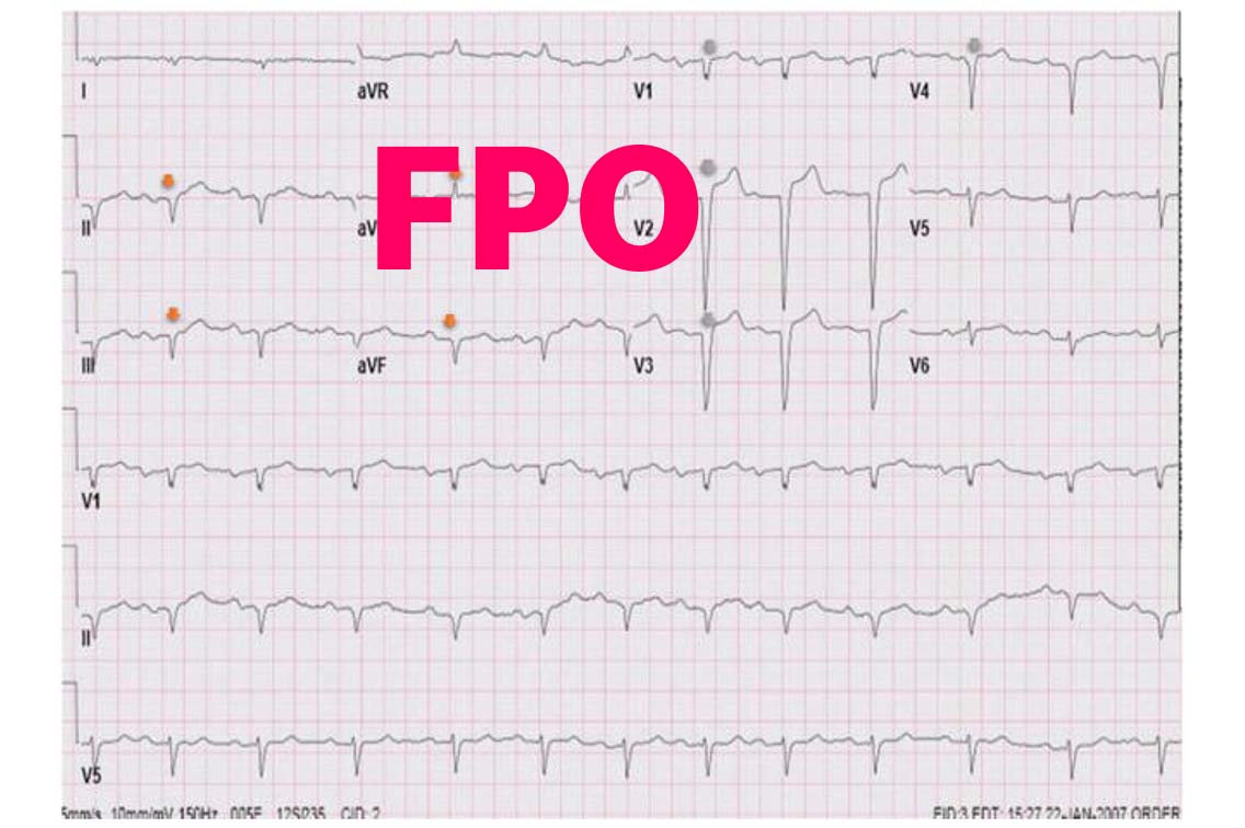 ECG tracing showing low‑voltage patterns and
conduction abnormalities across multiple leads
