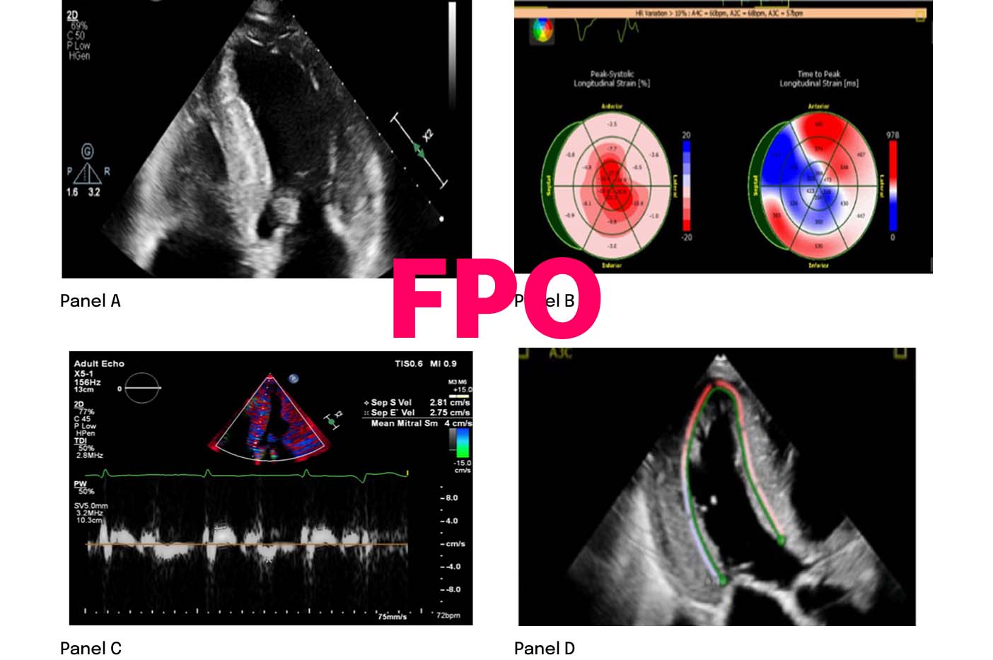 Echocardiography images showing cardiac
structure, strain mapping, and Doppler readings.