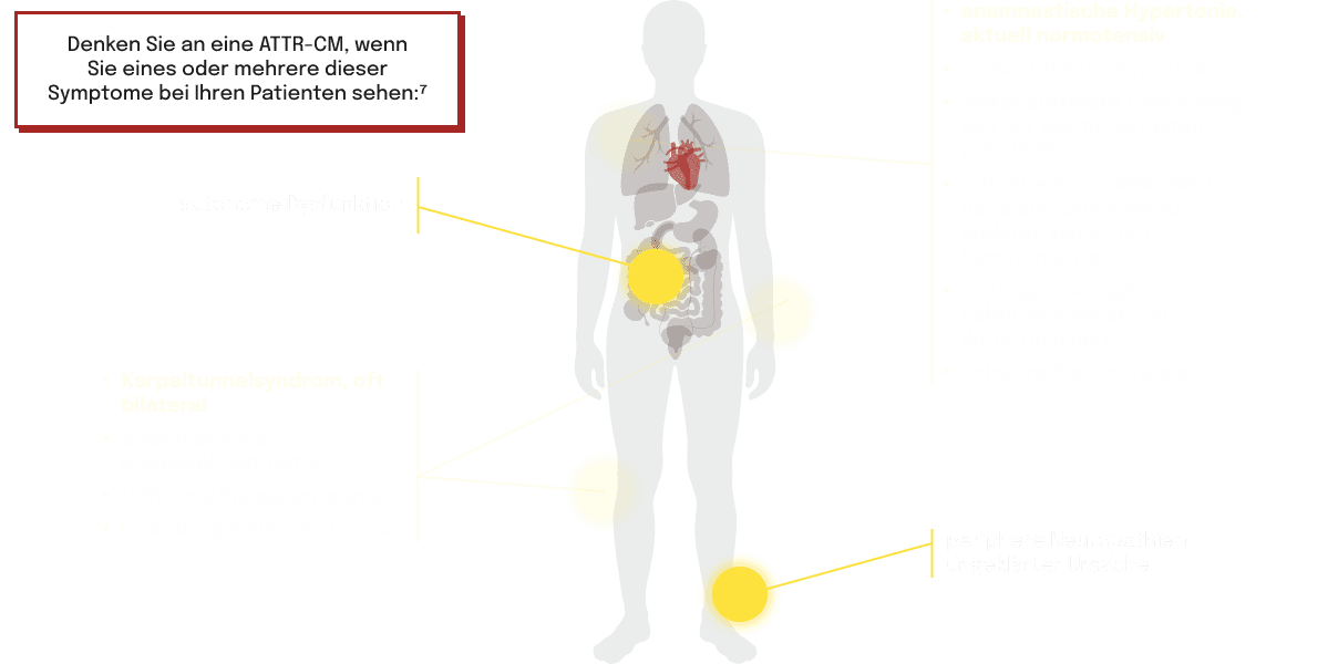 Körpergrafik mit hervorgehobenen
Symptombereichen, die häufig mit ATTR‑CM
assoziiert sind