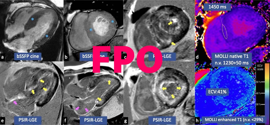 Cardiac MRI panels showing bSSFP cine views,
PSIR-LGE enhancement, and T1 mapping with
elevated ECV.