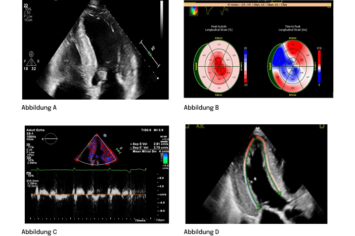 Echokardiografie‑Bilder mit Darstellung der Herzstruktur, Strain‑Mapping und Doppler‑Messungen