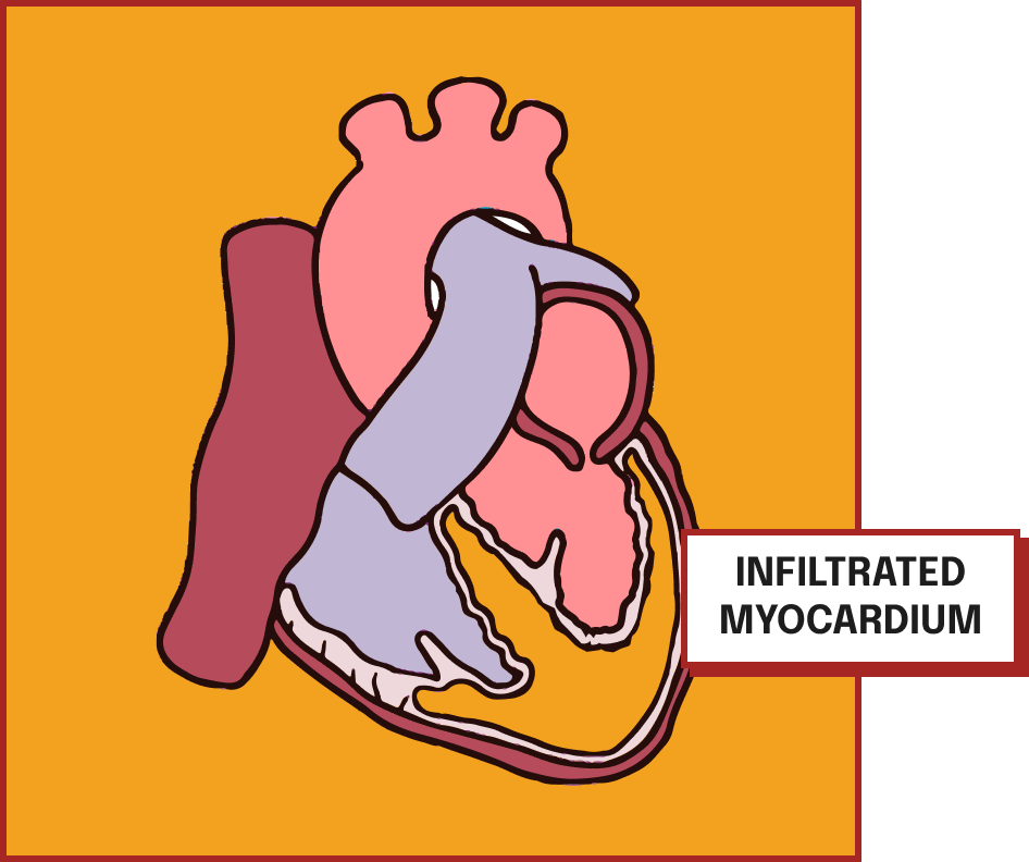 Medical illustration of a heart showing infiltrated myocardium