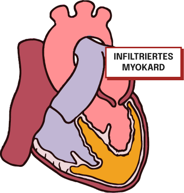 Medizinische Illustration eines Herzens mit infiltriertem Myokard