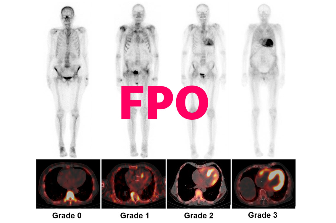 Bone scintigraphy images showing Perugini grades
0 to 3 with corresponding cardiac uptake patterns